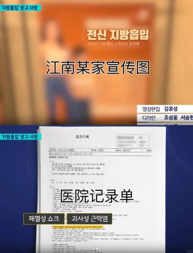 两周内三次抽脂，中国女孩命丧韩国！警方介入调查