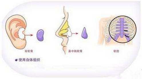 常见的四种隆鼻方法