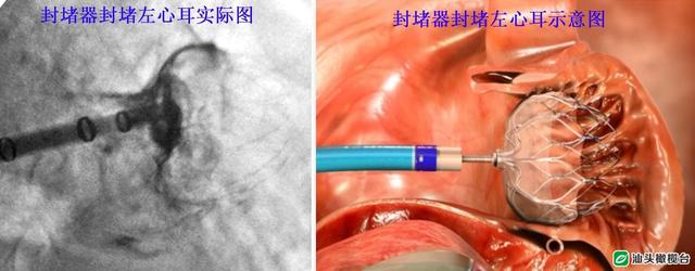 房颤患者的福音！汕大附一荣获汕头市首个“中国房颤中心”称号